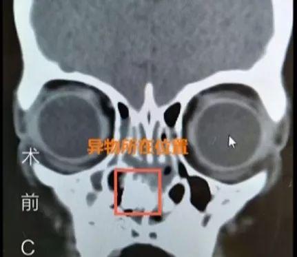 热点丨孩子身上窜出阵阵臭味，一看这里都坏死了，这辈子都受影响！