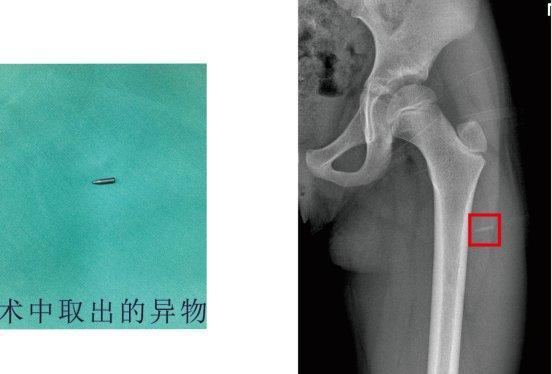 疼！7岁女童玩床上玩侧翻，铅笔刺入大腿滞留8小时
