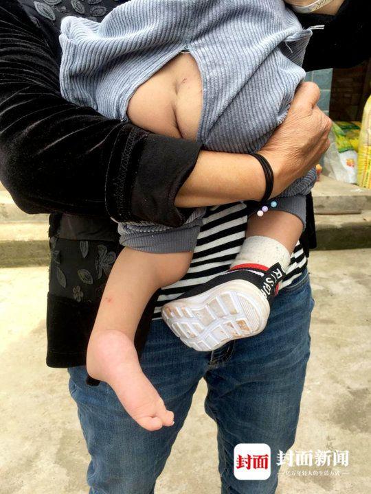 产检无异样却产下“畸形儿” 涉事医院：只负漏诊责任