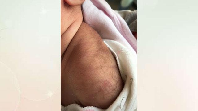 妈妈晒刚出生的宝宝，网友：为什么新生儿背上会长黑毛呢？