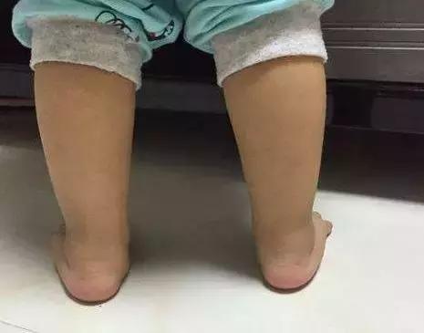 宝宝脚踝外翻，是有“病”吗？