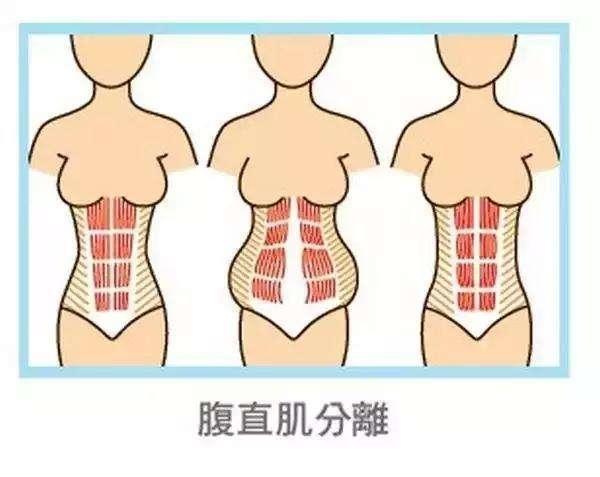 产后腹直肌分离怎么办？产妇腹直肌分离有哪些危害呢？