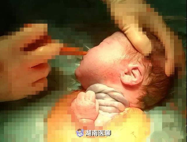 这个宝宝出生自带“五环”？腹中脐带绕颈5圈，脐带长达1米3！