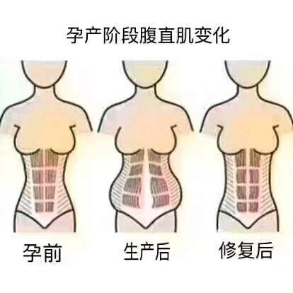 产后腹直肌分离怎么办？产妇腹直肌分离有哪些危害呢？