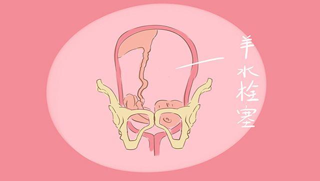 生产时羊水进入血液有多危险？医生：一旦发生，很难补救