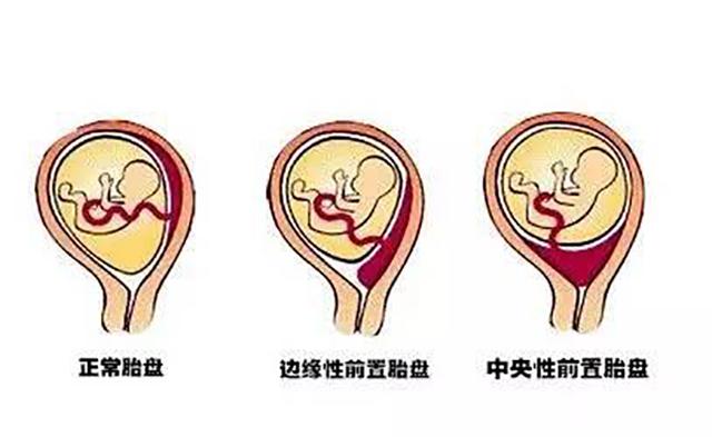 若是孕妈胎盘位置低，这个危险动作一定不要有，避免危及胎儿