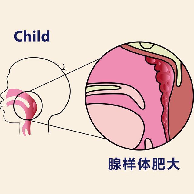 宝宝这种常见的小病，不重视就会毁容、毁智商！