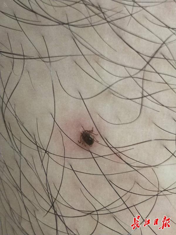 男孩被蜱虫叮咬，妈妈自行拔虫不当导致发热生病