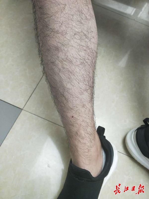 男孩被蜱虫叮咬，妈妈自行拔虫不当导致发热生病