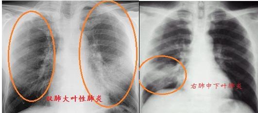 抽烟对糖尿病人有什么影响?