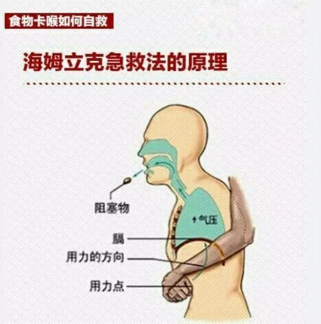 孩子异物卡喉：别拍背部！救人无数的海姆立克急救法一招搞定！