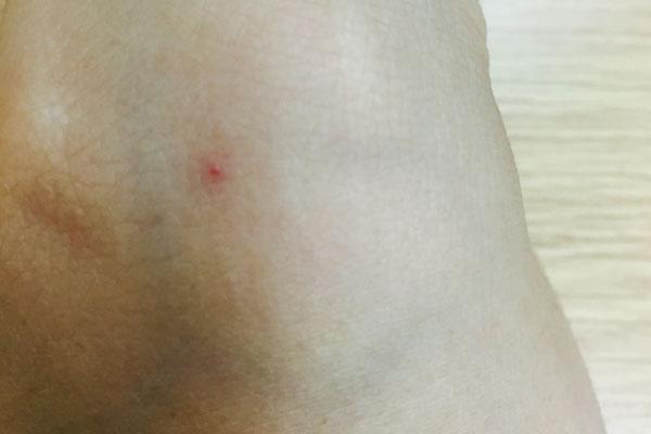 是血管瘤还是鲜红斑痣？如何鉴别婴儿时期的血管瘤？