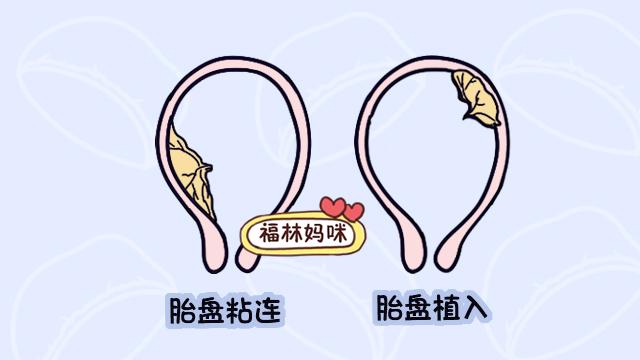 一胎剖以后都得剖？第二次剖腹产的感觉，过来跟告诉你