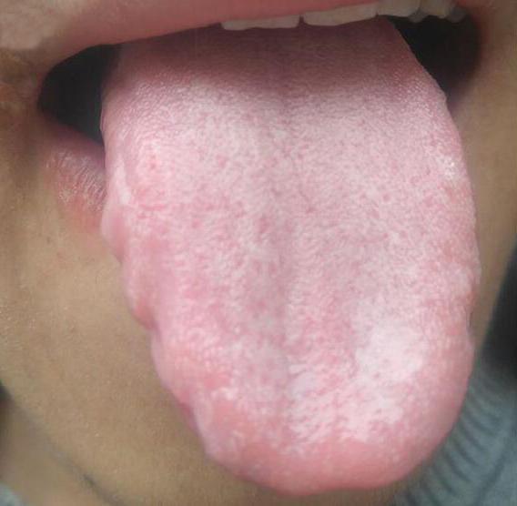 中医:珍贵实例舌诊秒懂肾阴亏虚