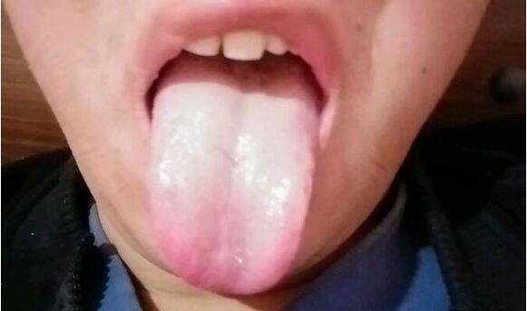 中医:珍贵实例舌诊秒懂肾阴亏虚
