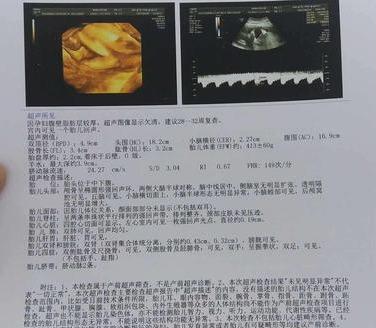 孕期四维彩超，检查报告的这几点能看懂，胎儿小秘密就了如指掌了