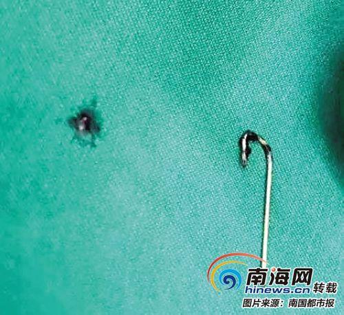 吓人！儋州1岁多男童玩着玩着吞下2.8厘米长鱼钩