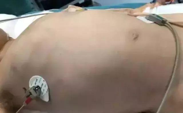 4岁男孩肚子大如怀孕，医生抽出2斤寄生虫液！身边的虫源要重视