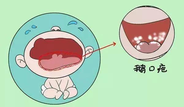 宝宝口腔里白白的是有问题吗？儿科医生说应该是这个疾病