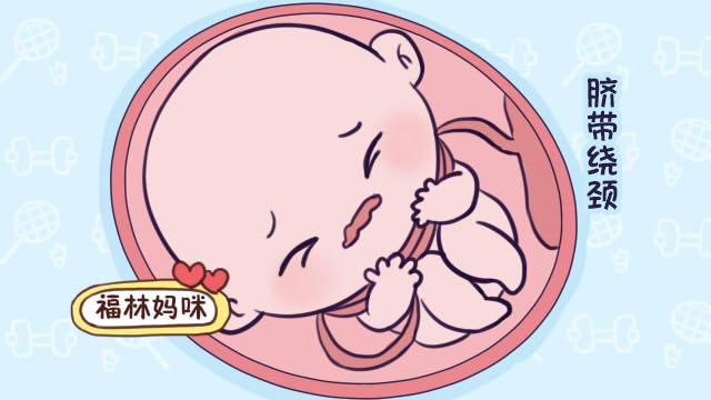 宝宝有多活泼，脐带就有多喜欢绕他脖子，脐带绕颈你知多少？