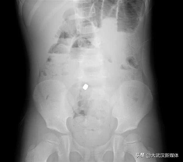 幼儿园睡午觉闲得无聊 男孩吞下两颗磁铁致肠穿孔