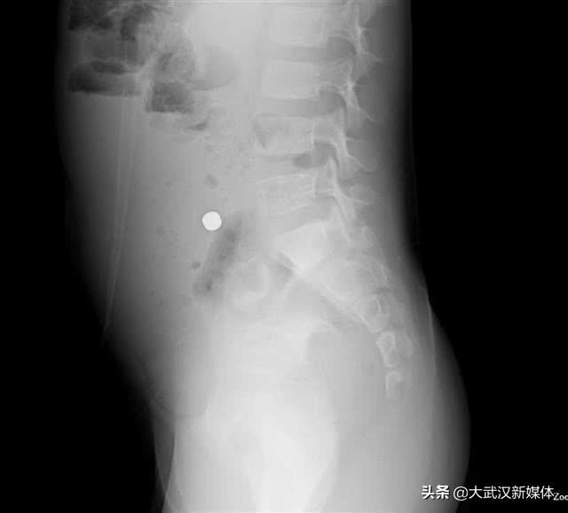 幼儿园睡午觉闲得无聊 男孩吞下两颗磁铁致肠穿孔
