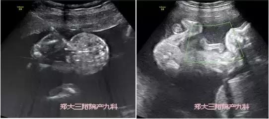 孕期双胞胎妈妈请注意：及早做超声检查，谨防双胎输血综合征！