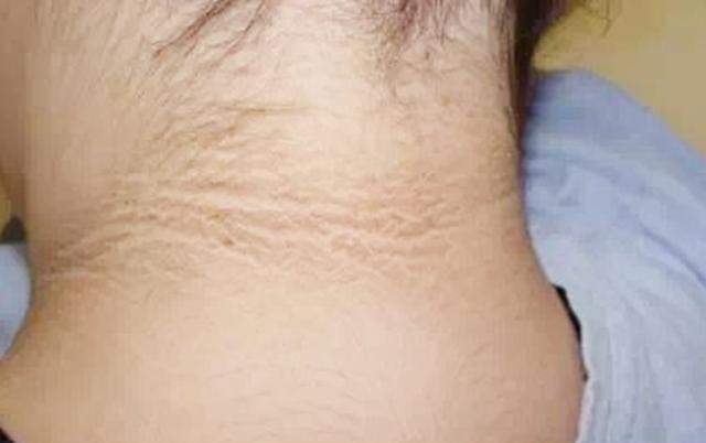 孩子后脖颈洗不掉的“黑污垢”，让宝妈自责不已，危害是多方面的