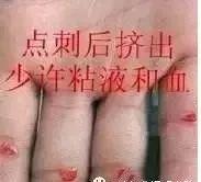 四缝穴，扎一次见效，二次痊愈