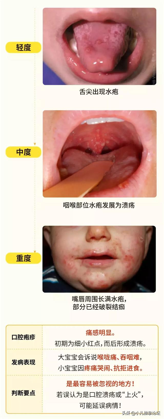 手足口病进入高发期，家长们快为宝宝们做好防护吧！