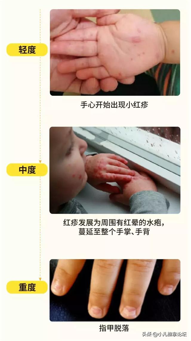 手足口病进入高发期，家长们快为宝宝们做好防护吧！