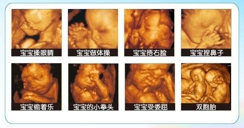 很想晒宝宝四维彩超照片，但宝宝拍出来很丑，孕妈很纠结怎么办？