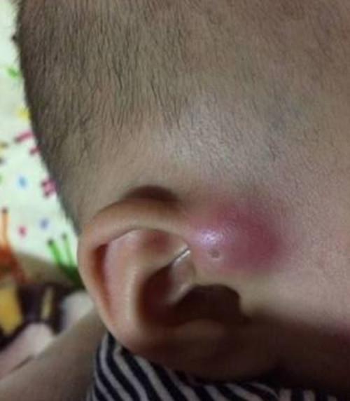 孩子耳边有个小孔，妈妈挤了下却因发炎要手术，这个孔你别乱碰