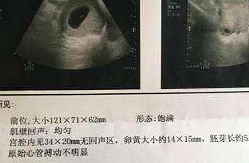 有了胎芽、胎心后,孕妈也不要掉以轻心,做好这些事,有助养胎