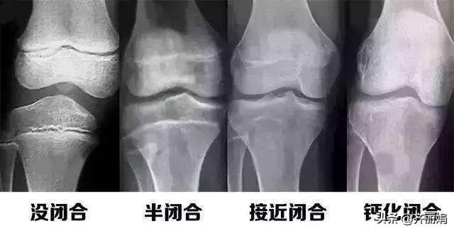 10岁女孩停止长高，医生检查后，原来和奶奶做的这件事有关