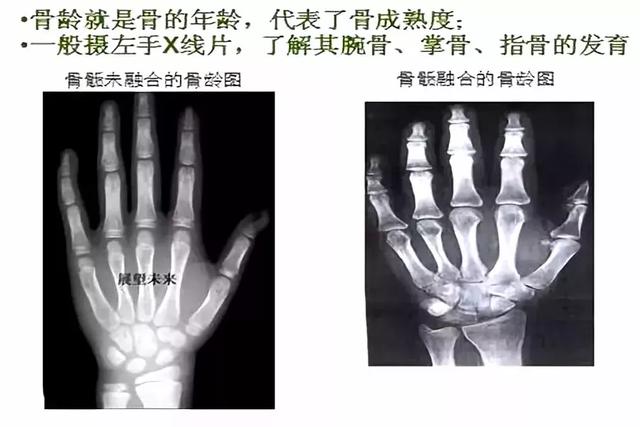 想知道孩子将来有多高？做个骨龄评估预测一下