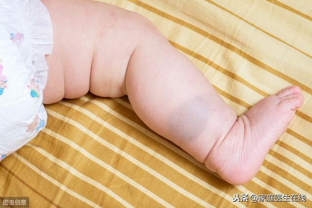 宝宝为什么会长胎记?可能是因为妈妈做了这几件事