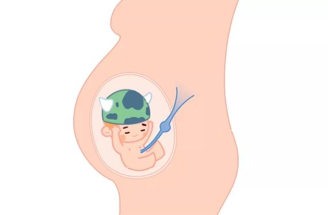 这种胎位还想顺产怎么办？产科医生给你支一招，保准比转胎药管用