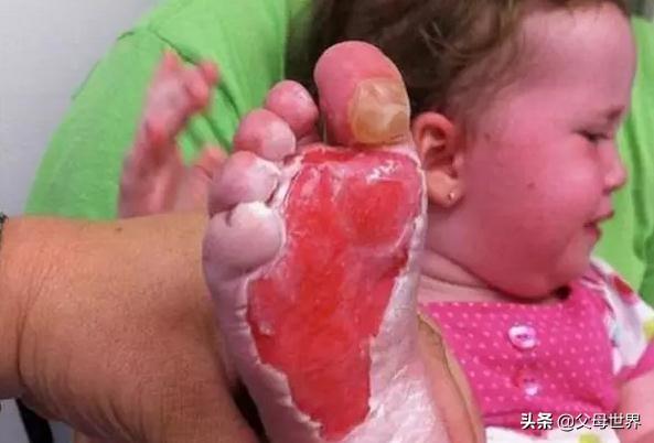 孩子烫伤后，最佳处理时间只有2分钟！急救措施，家长一定要知道