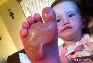 孩子烫伤后，最佳处理时间只有2分钟！急救措施，家长一定要知道