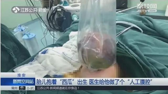 胎儿出生时竟抱着个“西瓜”，只因妈妈没注意到这点
