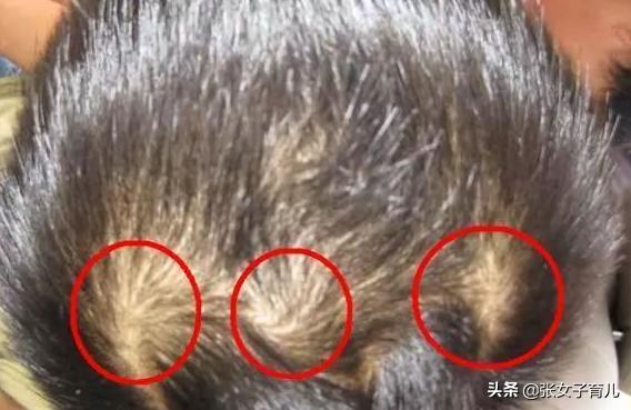 90后宝爸看了儿子头旋，变得愁眉苦脸，医生却这样说