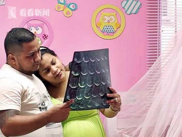 33岁女子孕检发现“胎中胎”手脚齐全却无心缺脑