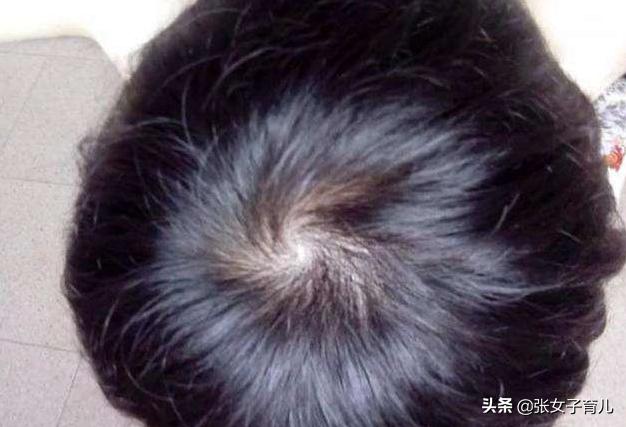 90后宝爸看了儿子头旋，变得愁眉苦脸，医生却这样说