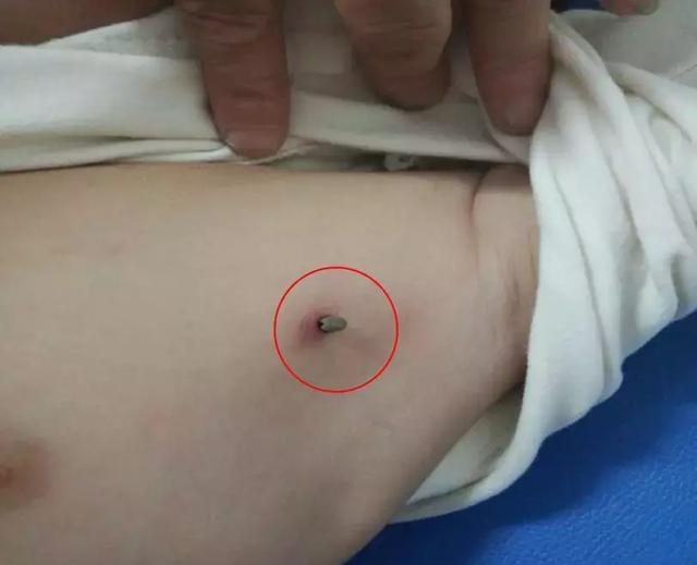 可怕！蜱虫钻入宝宝体内半截！医生：严重时可致死，勿大意