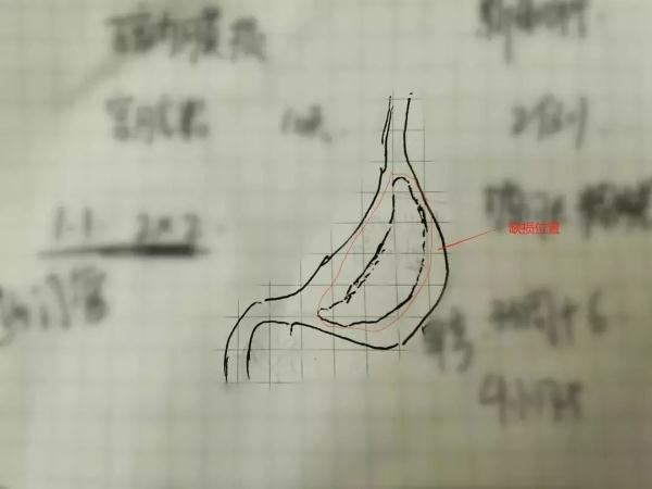 刚喝奶的新生儿肚子鼓成球，医生打开其腹腔时吓一跳：一股气体喷出