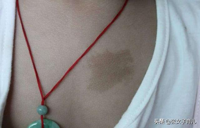 新生儿有胎记，成现代钟无艳，其实这可能都是孕妈的错