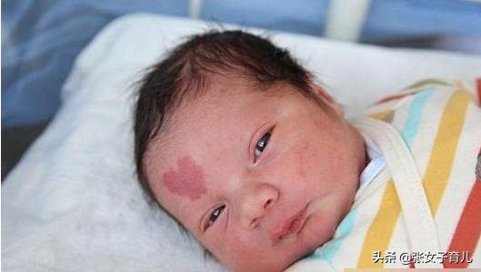 新生儿有胎记，成现代钟无艳，其实这可能都是孕妈的错