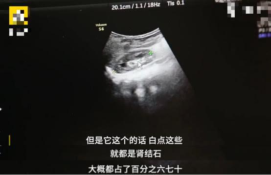 家长给9个月大宝宝过量补钙，致其长出大量肾结石，还无法做手术