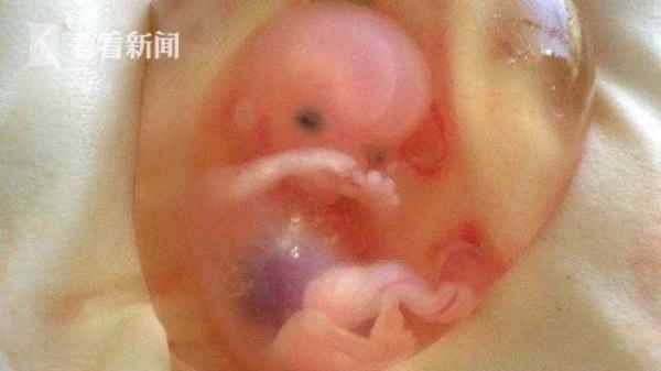 33岁女子孕检发现“胎中胎”手脚齐全却无心缺脑